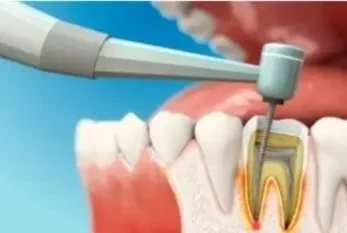 Эндодонтическое лечение пульпита 1 корневого зуба в Благовещенске