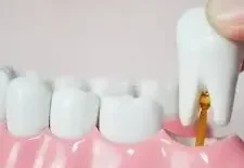 Удаление зуба для взрослых (щадящая методика с сохранением костной ткани)