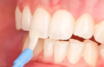 Покрытие зубов фторлаком (фторгелем)