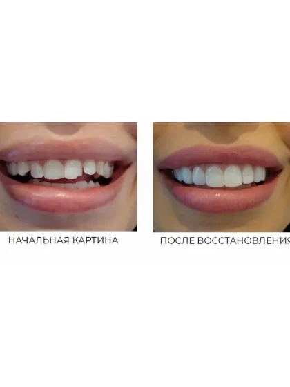 Реставрация зубов в Благовещенске