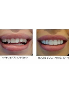 Реставрация зубов в Благовещенске