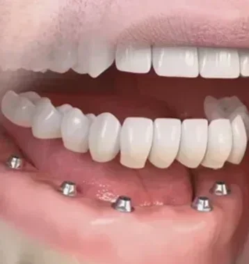 Имплантация All-on-6 (все зубы на 6 имплантах)