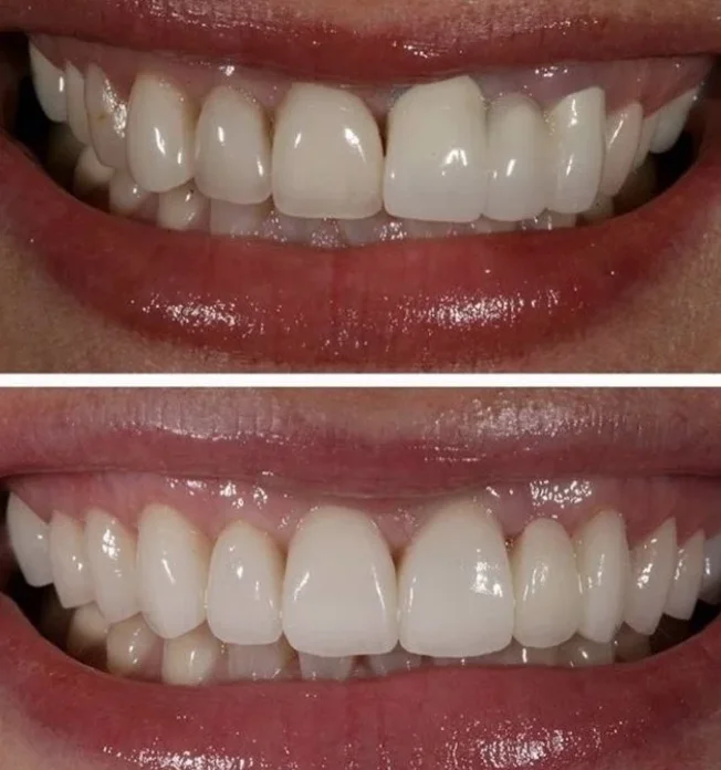 Восстановление зуба прямыми винирами. Пакет "Премиум"
