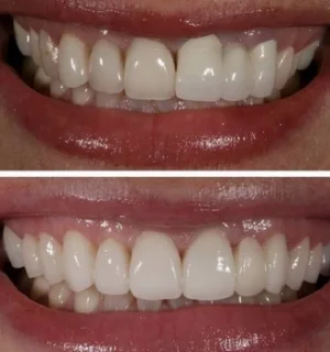 Фото для Восстановление зуба прямыми винирами. Пакет "Премиум"