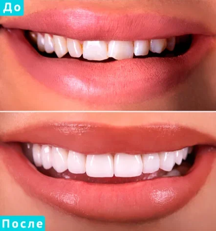 Несъемное протезирование: Восстановление зуба керамическим виниром (Emax)