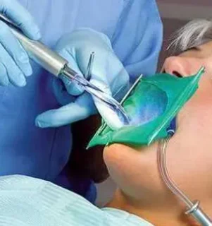 Ультразвуковое удаление зубных отложений в области зуба