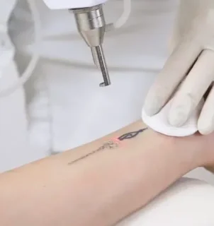 Удаление татуировок и татуажа лазером