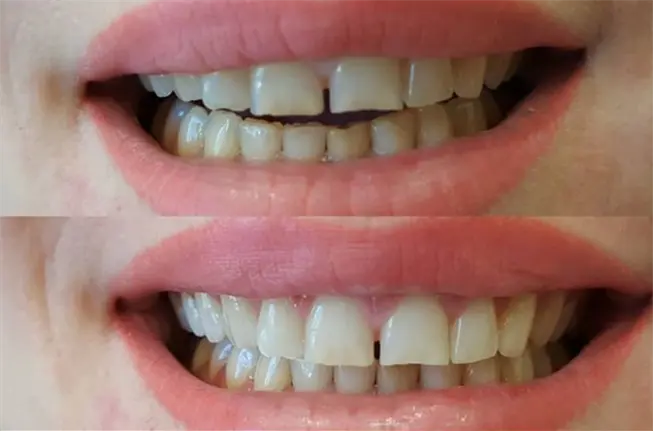 Экспресс отбеливание зубов, по технологии WhiteSmile