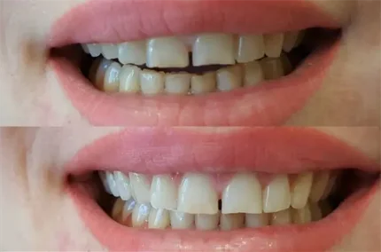 Фото для Экспресс отбеливание зубов, по технологии WhiteSmile
