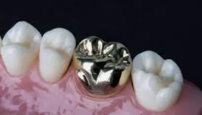 Протезирование зубов. Стальная литая коронка на жевательные зубы.