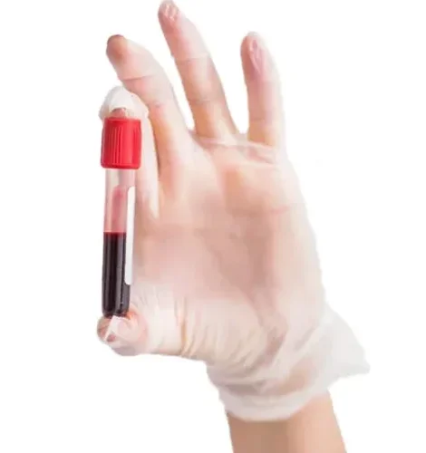 Клинический анализ крови: общий анализ, лейкоформула, СОЭ (с микроскопией мазка крови при наличии патологических сдвигов)